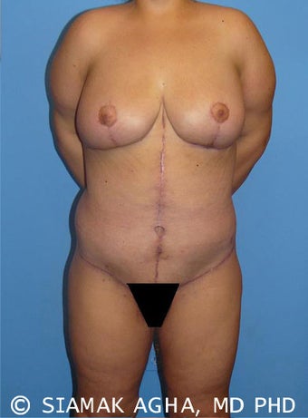 High-Definition™ Total Body Lift after 177427