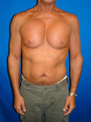 Pectoral Implants after 95038