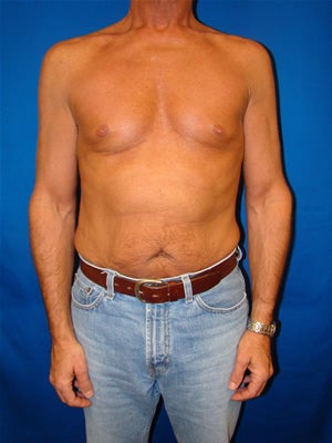 Pectoral Implants before 95038