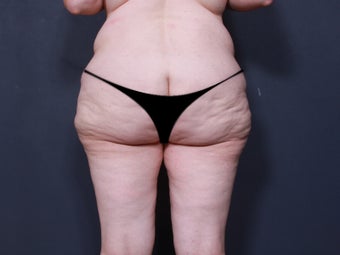 Body Lift 904688