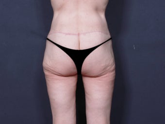 Body Lift 904688