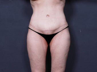 Body Lift after 904688
