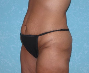 Circumferential Body Lift 857580