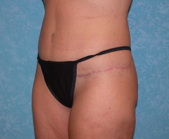 Circumferential Body Lift 857580
