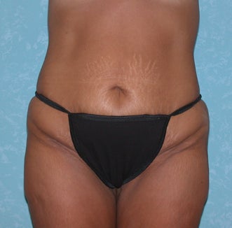 Circumferential Body Lift before 857580