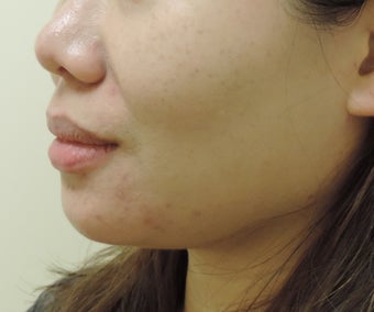 chin and jaw liposuction after 1181077