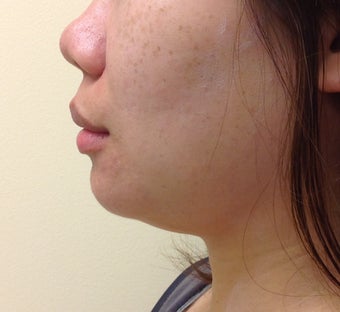 chin and jaw liposuction before 1181077