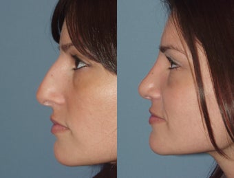 Female, Early 30's Looking to Minimize Bump before 827438