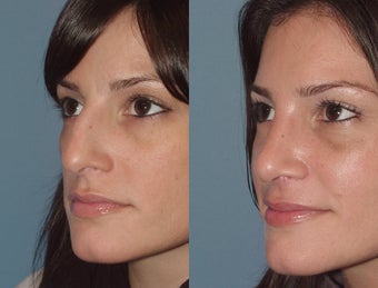 Female, Early 30's Looking to Minimize Bump 827438