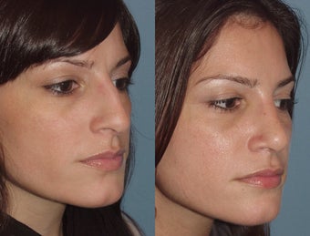 Female, Early 30's Looking to Minimize Bump after 827438