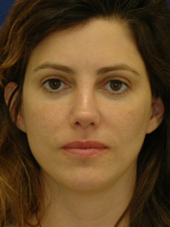 35 year old treated for Upper eyelid hollowing 641922