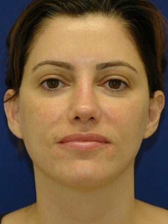 35 year old treated for Upper eyelid hollowing 641922
