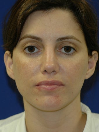 35 year old treated for Upper eyelid hollowing before 641922