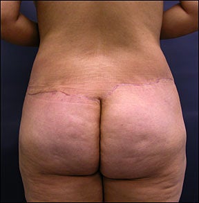 Butt Lift after 94596