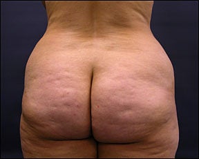 Butt Lift before 94596