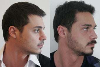 زراعة شعر الدقن
