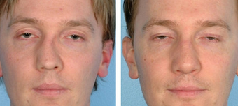 Functional Rhinoplasty before 1208309