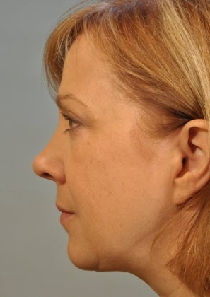 Lower lid Hetter Peel along with upper and lower eyelid surgery. 857701