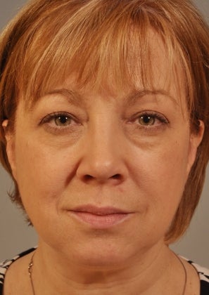 Lower lid Hetter Peel along with upper and lower eyelid surgery. before 857701