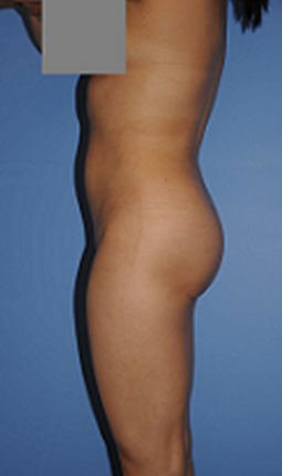 Buttocks Enhancement after 296685