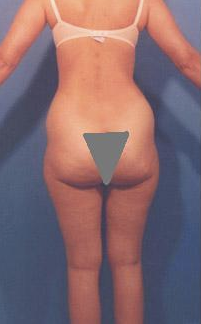 Buttocks Enhancement 296685
