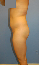 Buttocks Enhancement before 296685