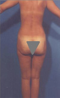 Buttocks Enhancement 296685