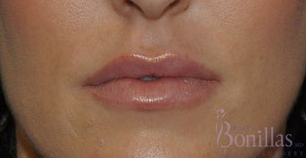 32 y/o female desired fuller lips with filler. after 1137124