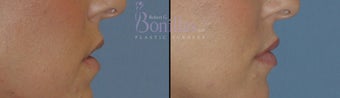32 y/o female desired fuller lips with filler. 1137124