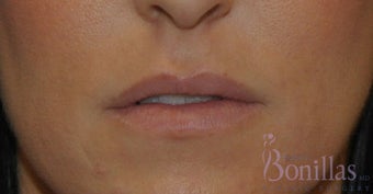 32 y/o female desired fuller lips with filler. before 1137124