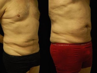 65 y/o Male SmartLipoTriplex of Abdomen, Waist and Flanks 1014459