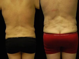 65 y/o Male SmartLipoTriplex of Abdomen, Waist and Flanks 1014459