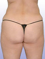 Smart Lipo before 1029367