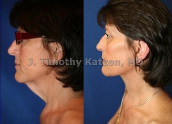 Neck liposuction only before 667231