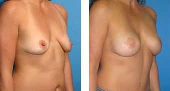 Breast Reconstruction: One-Stage Breast Reconstruction 561797