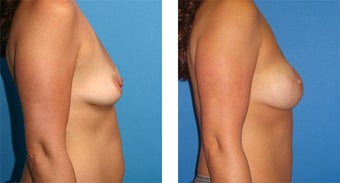 Breast Reconstruction: One-Stage Breast Reconstruction after 561797