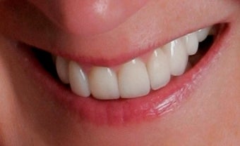 Porcelain Restorations: Bridge, Crowns, and Veneers after 889546