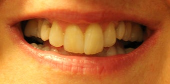 Porcelain Restorations: Bridge, Crowns, and Veneers before 889546