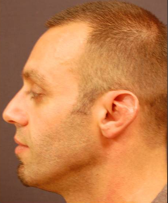 Otoplasty after 396303