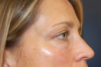 Juvederm dermal filler for upper cheek and under eyes after 730932