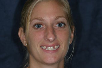 Congenitally Missing Teeth before 733259