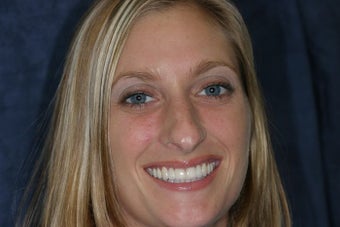Congenitally Missing Teeth after 733259