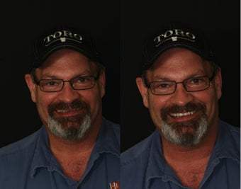 Facelift Denture before 1329276