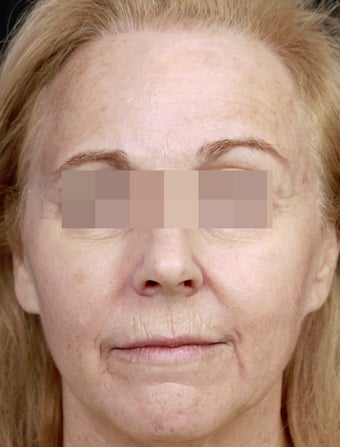 Fillers for Rejuvenation before 219217