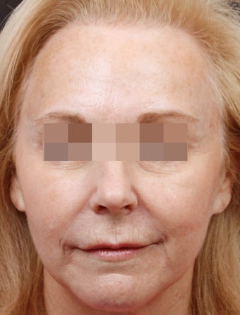 Fillers for Rejuvenation after 219217