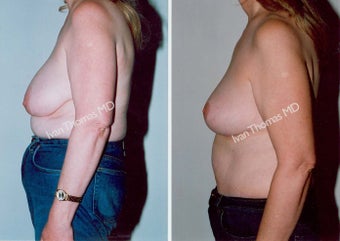 Mastopexy-Breast Lift before 243717
