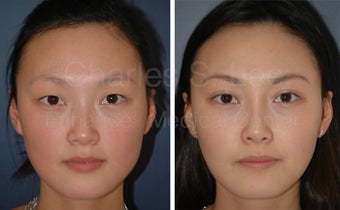Asian Eyelid Surgery before 815760