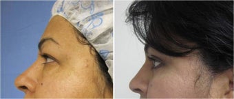 Blepharoplasty before 512850