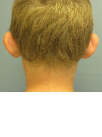 Otoplasty/Ear Surgery before 731977