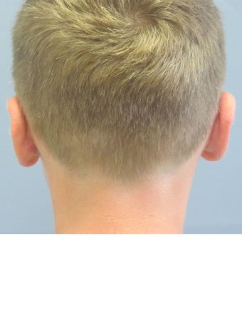 Otoplasty/Ear Surgery after 731977